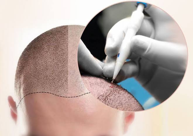 FUE Hair Transplant