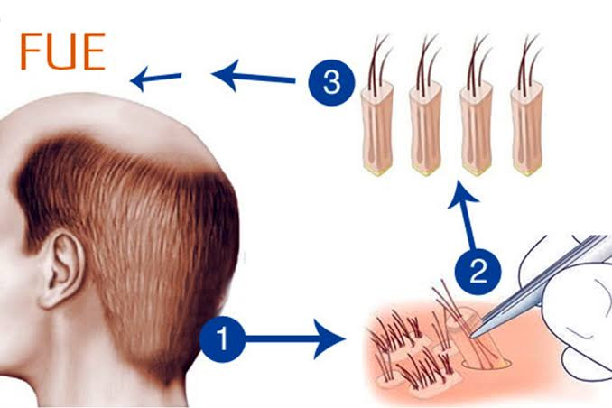 FUE Hair Transplant