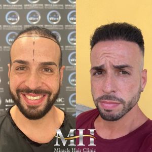 hair-transplant-4