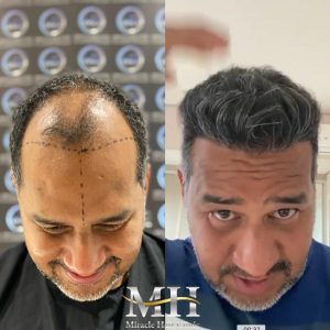 hair-transplant-in-turkey